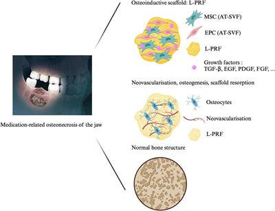 Treatment of medication-related osteonecrosis of the jaw with cell therapy